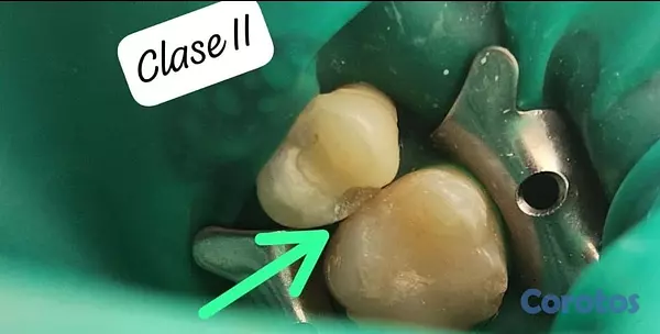 servicios profesionales - RESTAURA TUS CARIES 4