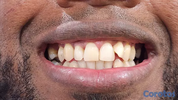 servicios profesionales - RESTAURA TUS CARIES 2