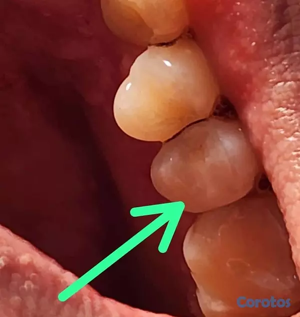 servicios profesionales - RESTAURA TUS CARIES 3